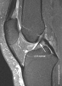 IRM_aspect_normal_LCA_ligament_croise_anterieur