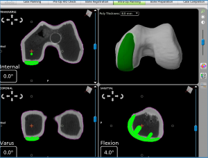 knee_planning-b8c60fabdbe6033b97d42de32f6d569f2580f23b4b4ffe1001cb36bb073bc58f