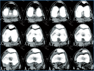 knee_scan-b548f2b0f5ca3e95e8ee5c2c9bed4ad03d73be07f96e0a8ba9541ea3f227be90