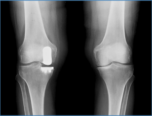 knee_xray-5ee7f0217e2b47ae93fd39d38a0bfabfb22ffaffb196056d8dd39fb4cfcbc5cd